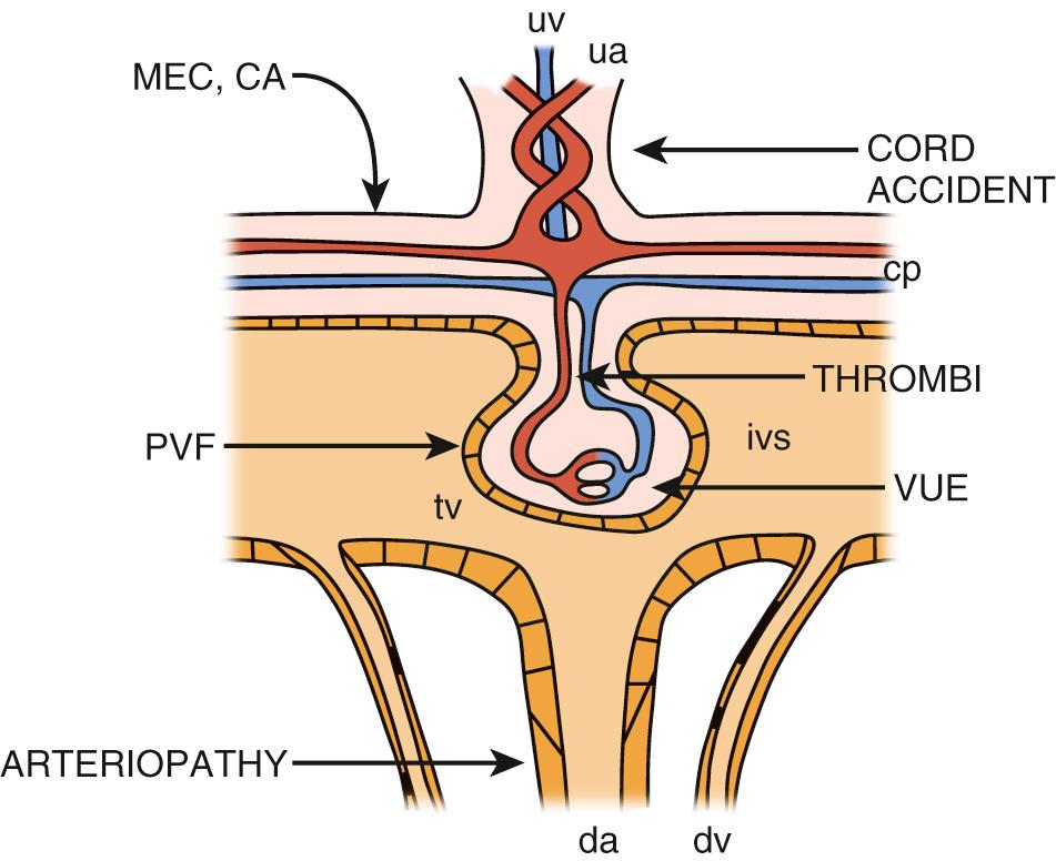 Fig. 26.2, Schematic diagram of a functional unit in the placenta, with sites and patterns of injury indicated by arrows. Deoxygenated fetal blood enters the placenta via umbilical arteries ( ua ) and flows through the chorionic plate ( cp ) and stem villous arteries before entering terminal villi ( tv ). Flow into capillaries is regulated by stem villous arterioles. Postcapillary venules combine to form stem villous and chorionic plate veins, which drain into a single umbilical vein ( uv ) that carries oxygenated blood to the fetus. Maternal blood enters the intervillous space ( ivs ) via decidual arteries ( da ) lined with the trophoblast ( hatched lines ) and drains through unmodified decidual veins ( dv ). Decidual arteriopathy restricts maternal perfusion of the intervillous space. Perivillous fibrin ( PVF ) coats the villous trophoblast ( hatched lines ), preventing gas exchange. Villitis of unknown etiology ( VUE ) expands the villous stroma, increasing the diffusion distance. A cord accident compresses the umbilical vessels, causing a global decrease in fetoplacental circulation. Meconium ( MEC ) and chorioamnionitis ( CA ) may decrease villous perfusion by damaging fetal vessels in the chorionic plate. Segmental fetal vascular malperfusion ( THROMBI ) similarly decreases the distal fetal vascular bed.