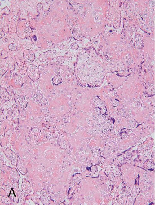 Fig. 26.3, Histologic patterns of placental injury. A, Massive perivillous fibrin deposition. Fibrin and fibrinoid matrix encase the terminal villi. B, Chronic maternal vascular malperfusion (accelerated villous maturation). Numerous aggregates of syncytiotrophoblastic nuclei (syncytial knots) surround immature villi of reduced size for gestational age. C, Segmental fetal vascular malperfusion. Avascular villi ( lower right ) resulting from upstream vascular occlusion. D, Villitis of unknown etiology ( VUE ). Maternal T lymphocytes in the fetal villous stroma ( lower right ) lead to edema and fibrosis, which increase the diffusion distance between the maternal and fetal circulations.