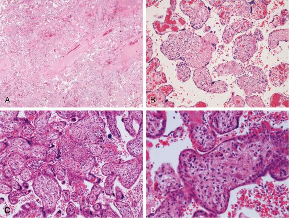 • Fig. 9.1, Photomicrographs of placental histology demonstrating extensive villitis of unknown aetiology. ( A and B ; haematoxylin and eosin (H&E) original magnifications ×20 and ×100, respectively) and congenital toxoplasmosis. C and D ; H&E original magnifications ×40 and ×200, respectively.)