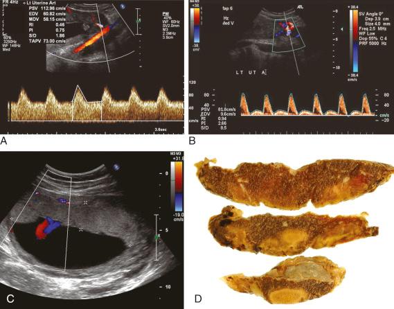• Fig. 9.4, Normal ( A ) and abnormal ( B ) uterine artery Doppler waveforms. Abnormal flow is associated with fetal growth restriction with placental hyperinflation ( C ) caused by maternal vascular malperfusion and placental infarction ( D ).