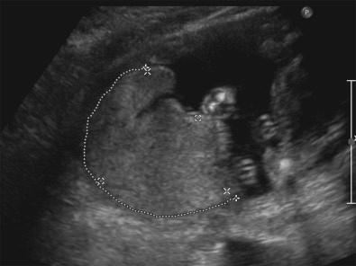 • Fig. 9.5, Abnormally appearing ‘hyperinflated’ placenta in association with low first trimester serum placental associated protein A (PAPP-A) and early-onset fetal growth restriction (see Video 9.1 ).