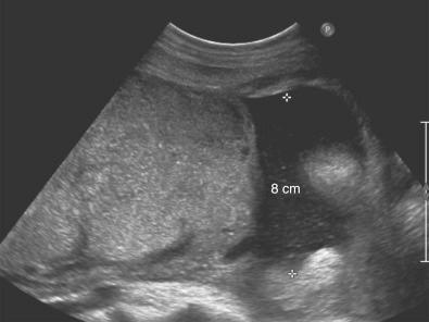 • Fig. 9.6, Massive placentomegaly with nonimmune fetal hydrops at 32 weeks’ gestation caused by fetomaternal haemorrhage. The mother showed features of ‘mirror syndrome’.