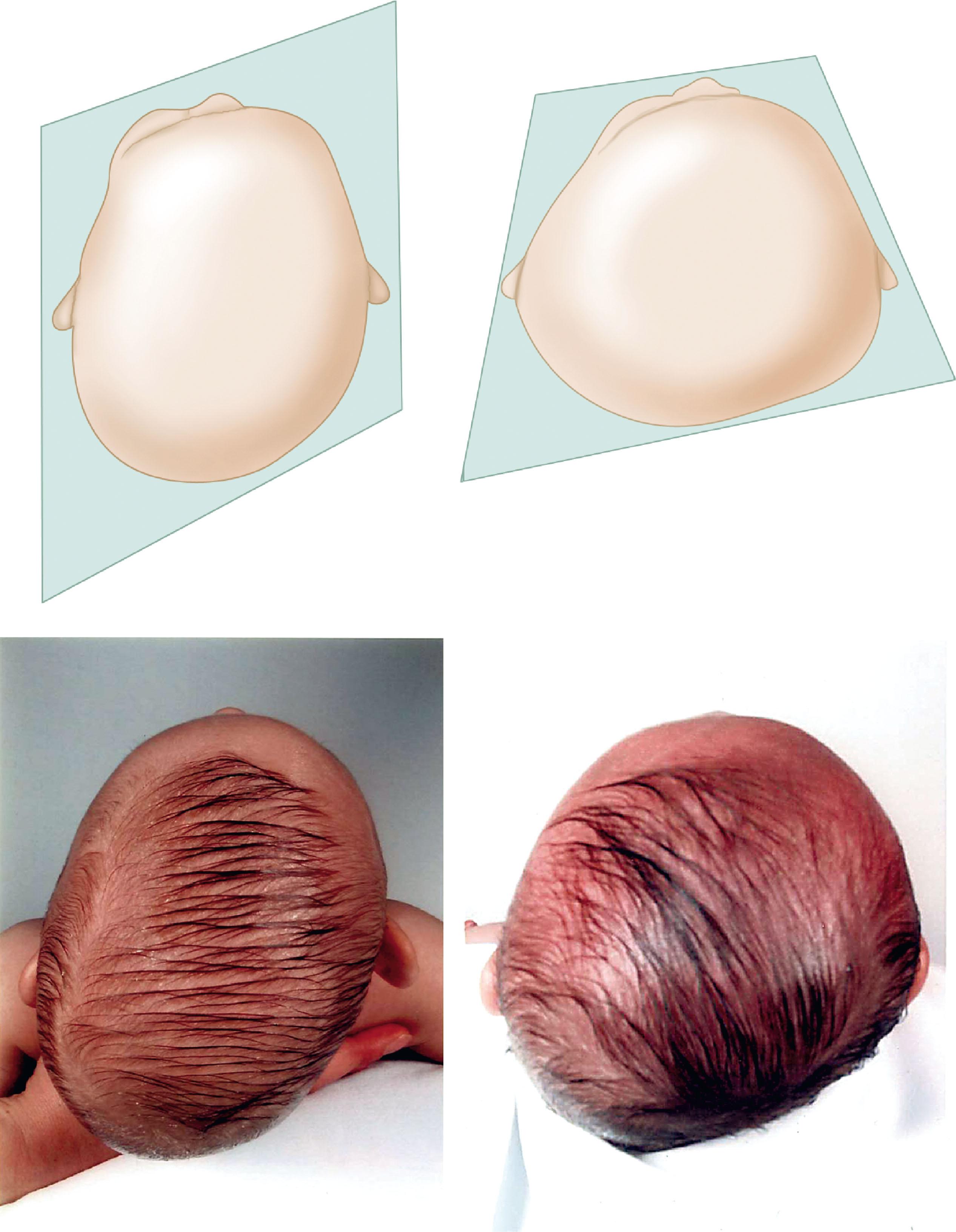 FIGURE 25.1, These infants demonstrate typical head shapes for deformational posterior plagiocephaly when viewed from the top (parallelogram on the left and trapezoidal on the right ). The more brachycephalic head shape on the right suggests very little tummy time.