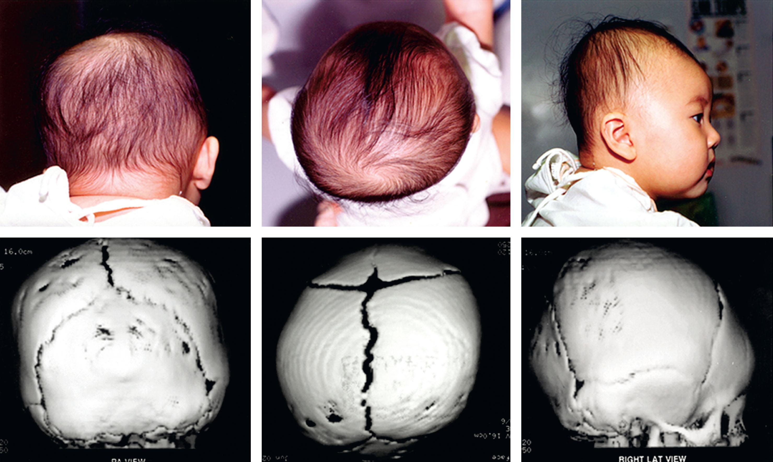 FIGURE 25.2, This 6-month-old infant was referred for an altered head shape resulting from deformational plagiocephaly with left torticollis and associated brachycephaly with right occipital flattening. A cranial 3D computed tomography scan had been done previously and clearly showed patent sutures. She responded well to neck physical therapy and cranial orthotic therapy.