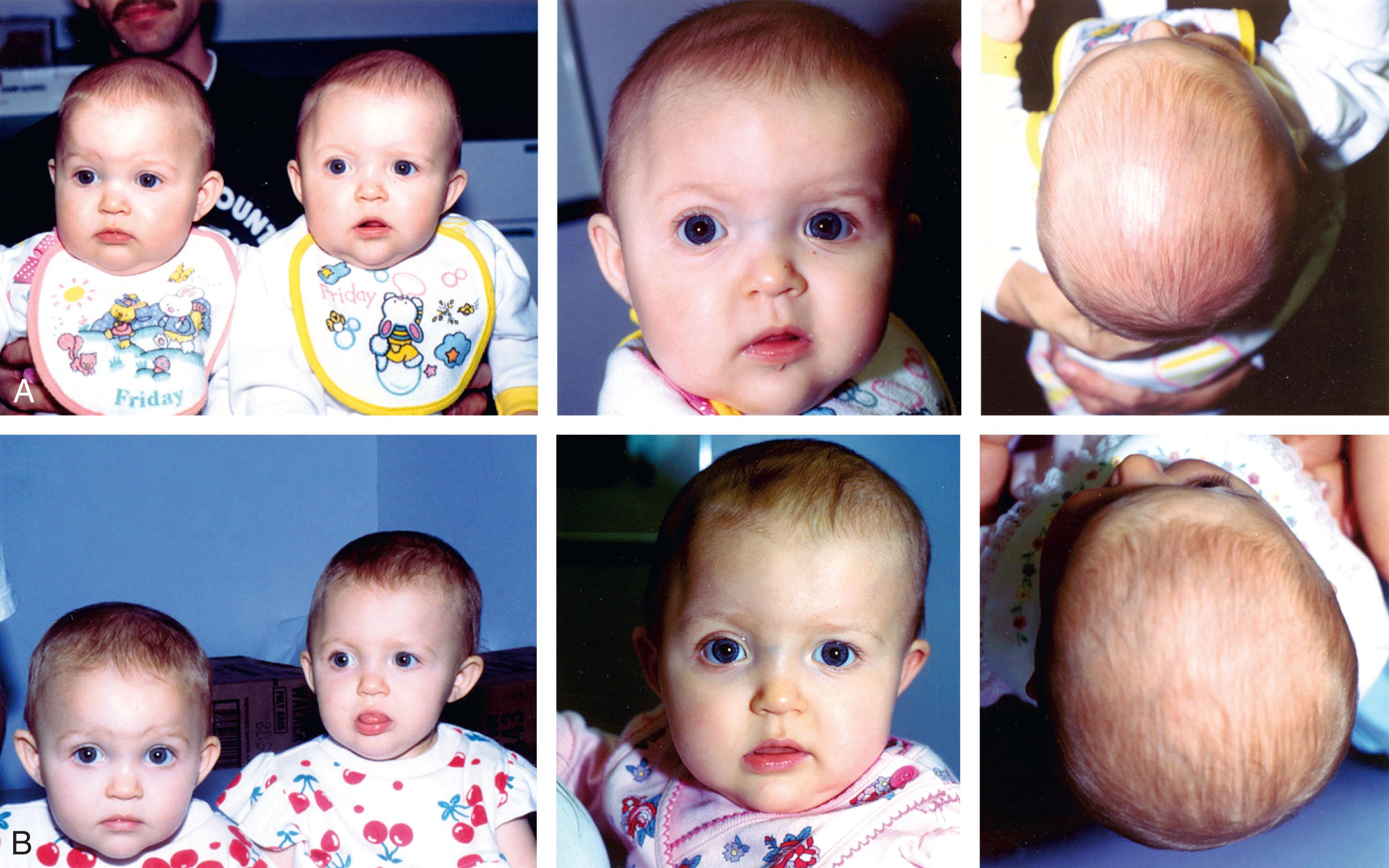 FIGURE 25.4, These monozygotic twins show how residual torticollis-plagiocephaly deformation sequence caused the twin on the right to manifest persistent craniofacial asymmetry between ages 6 ( A ) and 10 months ( B ). The affected twin was beneath her co-twin in vertex presentation with her back to the mother’s left side and her head turned to the right.