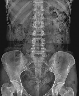 Figure 1-1, Normal anteroposterior abdominal plain film.