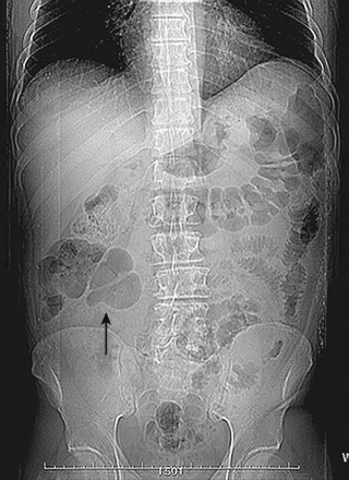 Figure 1-2, Diverticulitis and peridiverticulitis. There is no evidence of bowel distention at the level of either the colon or the small bowel. It is possible to see a mild air dilation of the small bowel. The cecum seems to be medially moved (arrow).