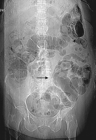 Figure 1-3, Mesenteric ischemia and spleen infarction. Abdominal radiograph shows a colonic dilation (arrow) that is especially marked at distal segments. Furthermore, extracolonic air collections are visible at the spleen level (arrowhead) in the upper left quadrant. Bowel dilation is evident without the finding of bowel obstruction.