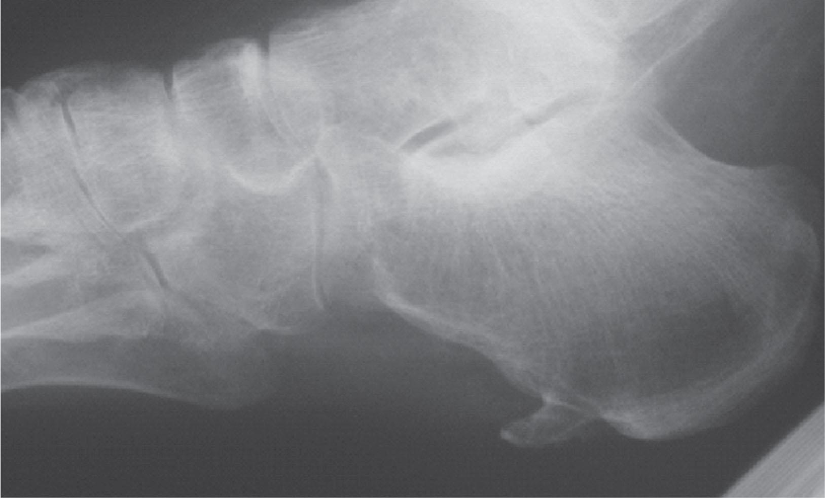 Fig. 12-1, A large heel spur is seen on the calcaneus with extension into the flexor digitorum brevis.