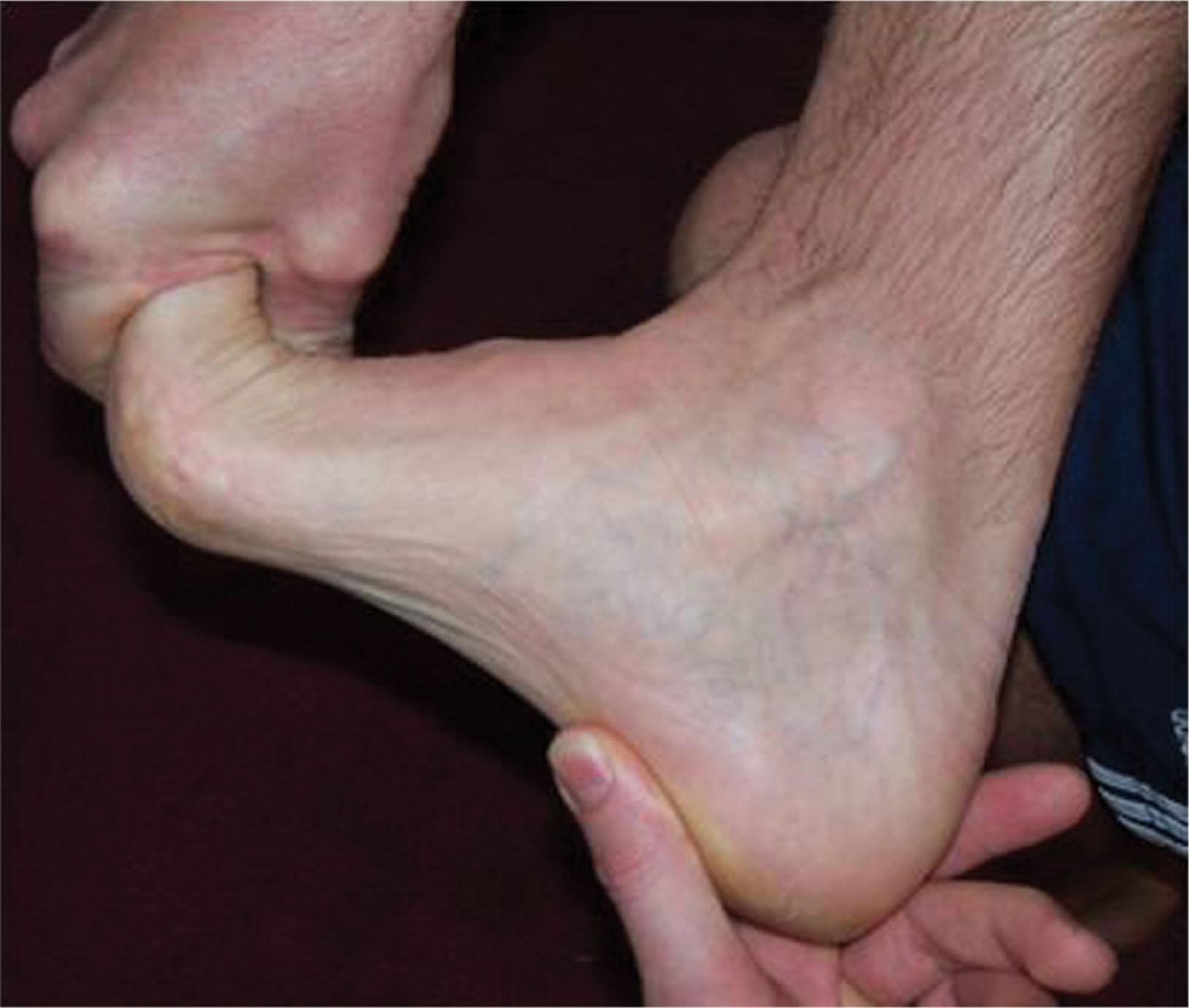 Fig. 12-11, The plantar fascia–specific stretch exercise. The patient pulls the ankle and toes into a dorsiflexed position, engaging the windlass mechanism, and placing the plantar fascia on stretch. Concurrently, the patient massages the taut bands of the plantar fascia.