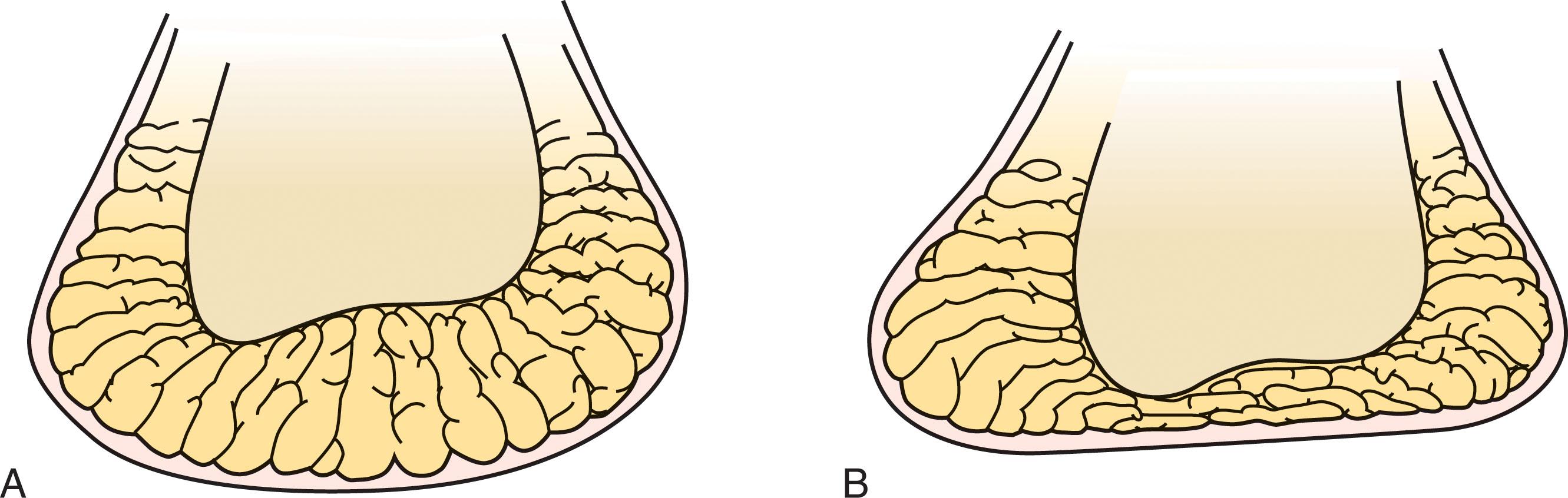 Fig. 12-4, Coronal sections of a normal heel pad. A , Non–weight bearing and B , weight bearing.