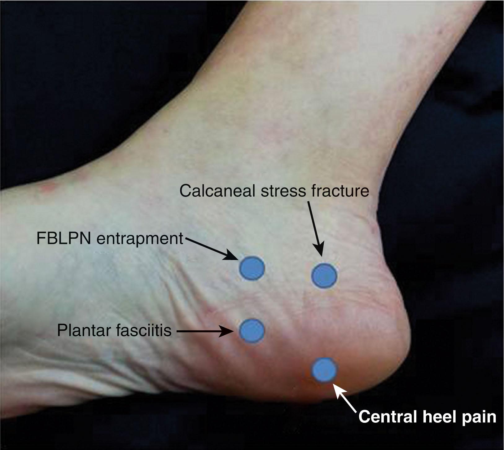Fig. 12-5, Physical examination findings of tenderness indicative of calcaneal stress fracture, first branch of the lateral plantar nerve (FBLPN) entrapment, proximal plantar fasciitis, and central heel pain.