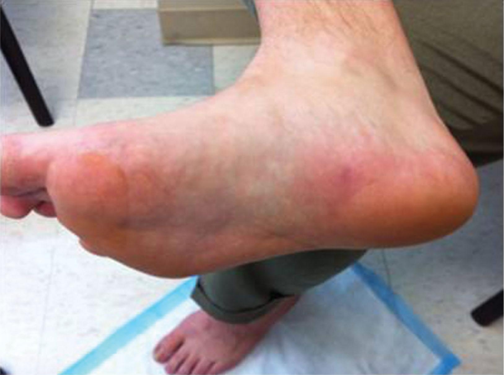 Fig. 12-6, Plantar ecchymosis near the origin of the plantar fascia indicative of an acute plantar fascia rupture.