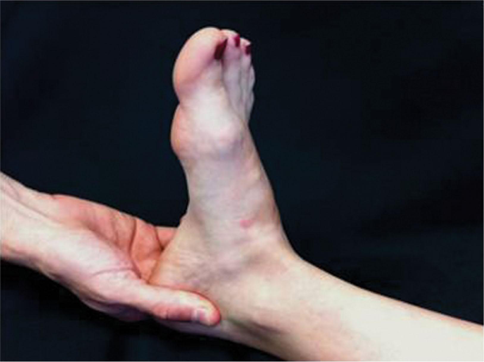 Fig. 12-7, The calcaneal squeeze test: a medial–lateral compression of the calcaneal tuberosity. Pain with this test may be indicative of a calcaneal stress fracture.