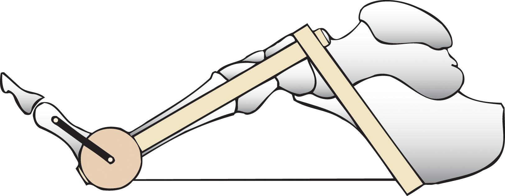 Fig. 12-8, Dorsiflexion of the toes causes tension on the plantar fascia. This is the windlass effect of the plantar fascia.