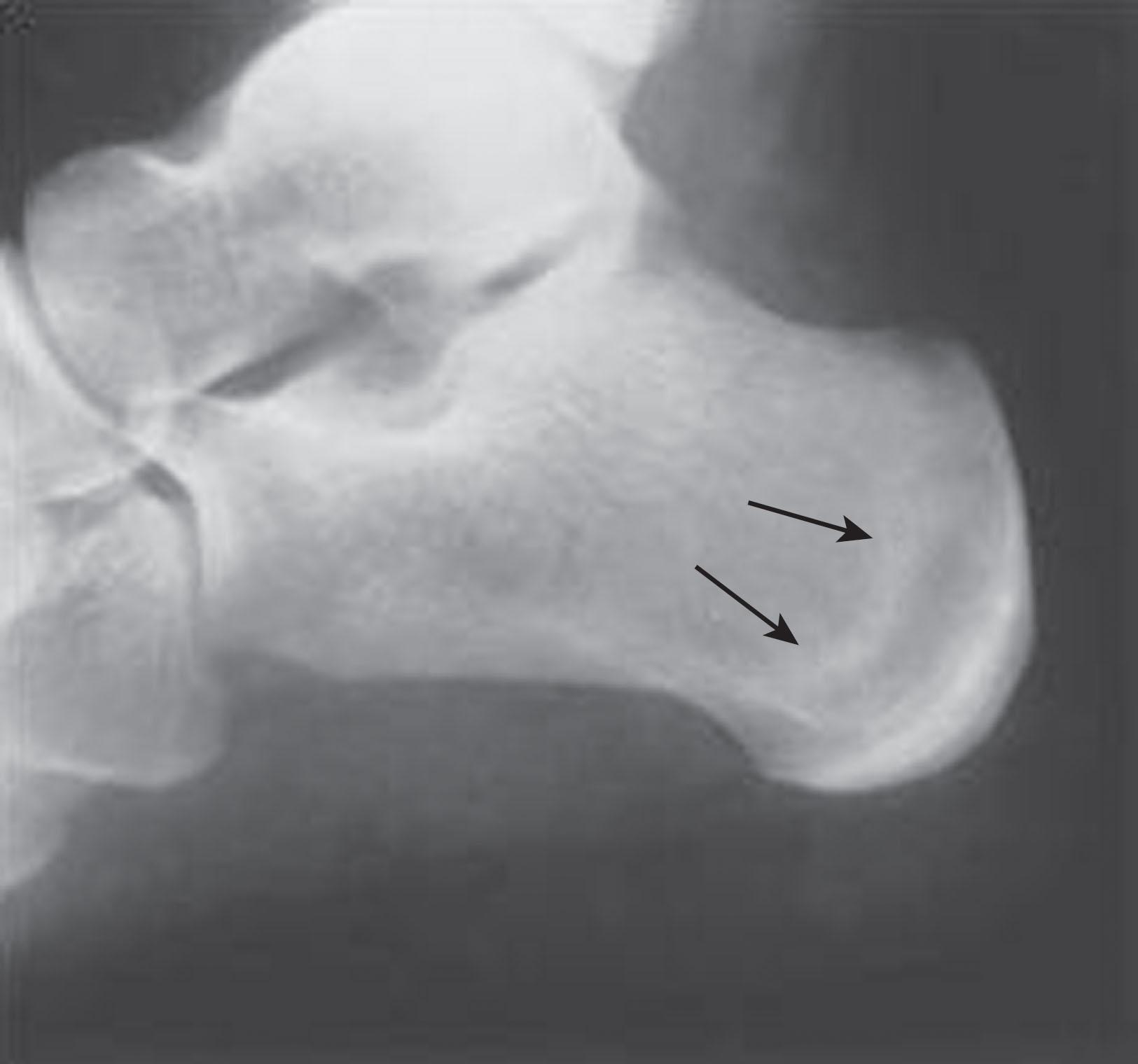 Fig. 12-9, Radiograph demonstrating stress reaction of the calcaneus (arrows) .