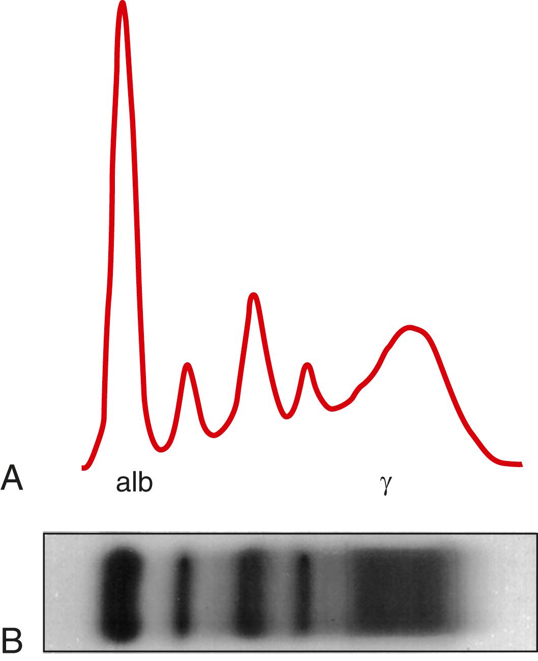 FIGURE 173-2, Serum protein electrophoresis showing increased polyclonal immunoglobulins.