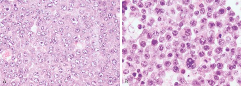 Figure 25-1, Plasmablastic lymphoma, cytologic variants.