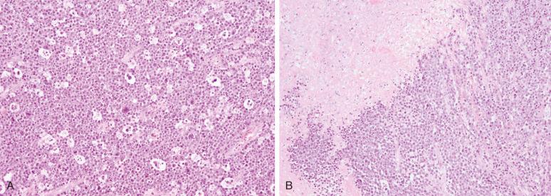 Figure 25-2, Plasmablastic lymphoma.