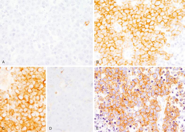 Figure 25-3, Plasmablastic lymphoma phenotype.