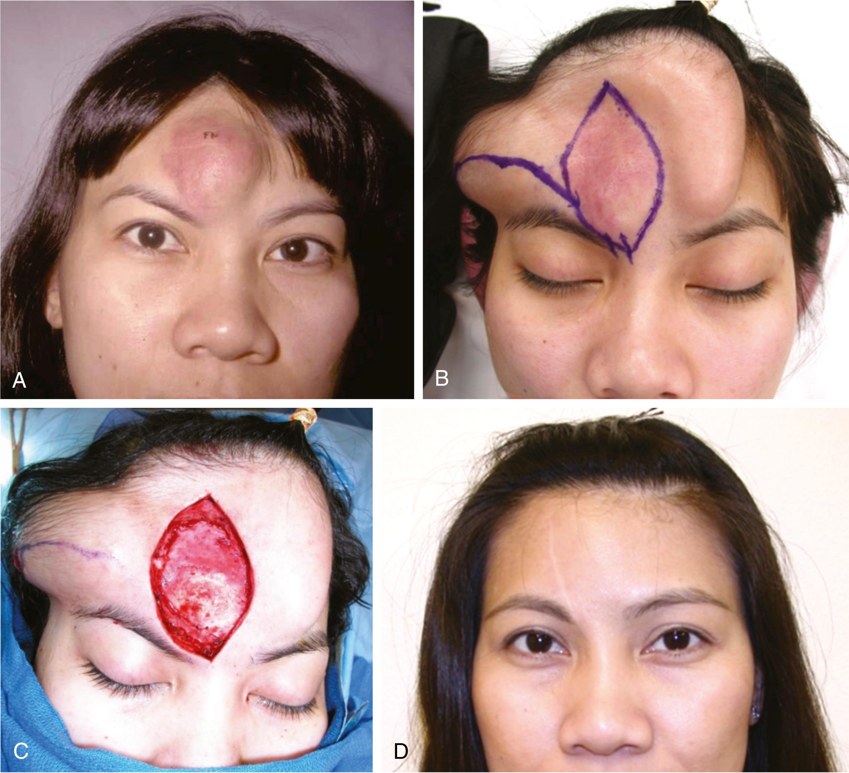 Fig. 69.1, The use of tissue expansion to generate new soft tissue to restore the forehead and hairline. The expanders are placed under tissue that best matches the lost tissue. (A) Young woman with an arteriovenous malformation. (B) Crescent-shaped expander in the central forehead and rectangular expander in the right forehead were expanded gradually with saline during one month. (C) The vascular lesion is excised, and the expanders will be removed with mobilization of the forehead to close the defect. (D) Postoperative result one year after surgery.