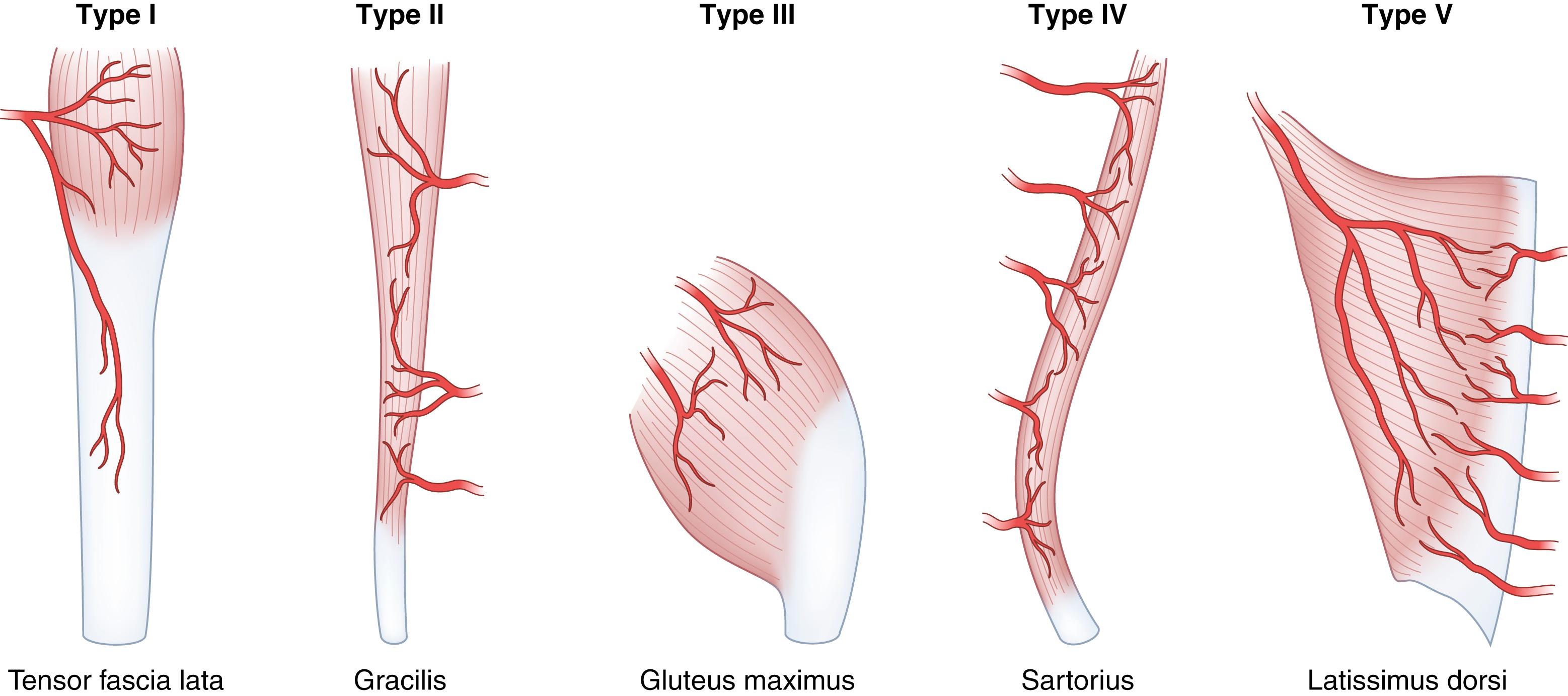 Fig. 69.2, Classification of muscle and musculocutaneous flaps according to their vascular supply: type I, one vascular pedicle; type II, dominant pedicle and minor pedicles; type III, two dominant pedicles; type IV, segmental vascular pedicles; type V, one dominant pedicle and secondary segmental pedicles.