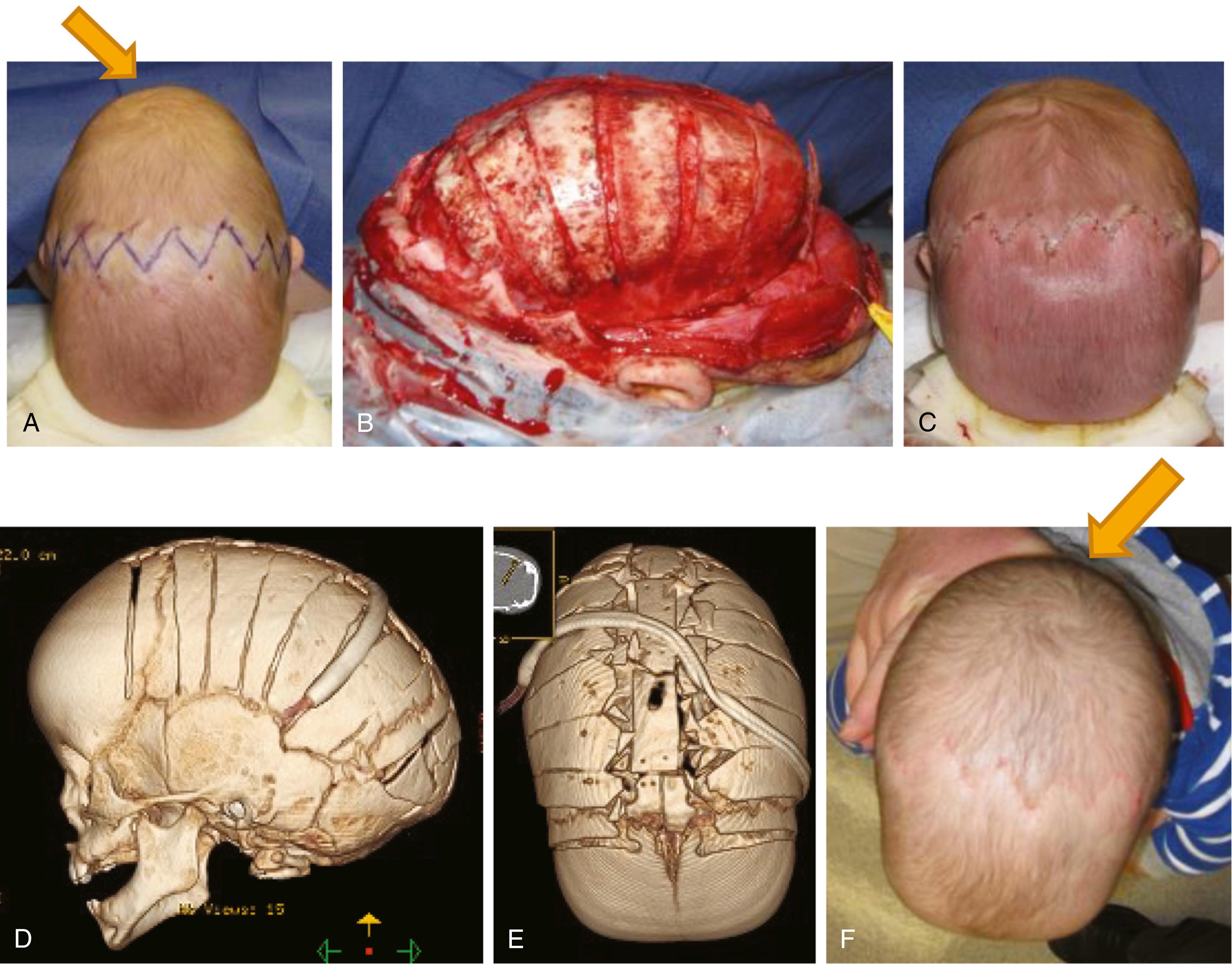 Fig. 69.4, Infant with sagittal suture craniosynostosis. (A) Preoperative view showing scaphocephalic head shape. The baby is in a prone position with the face resting on foam. Note the narrow biparietal dimension of the head, typical for this condition (arrow) . A zigzag coronal incision is designed to be better hidden once hair grows. (B) Intraoperative lateral view. The sagittal suture has been removed and reshaped, and lateral barrel stave osteotomies are created to reshape the cranial vault and to relieve growth restriction. (C) On-table view immediately after the procedure. The biparietal area is widened. (D and E) Lateral and superior views of the postoperative CT scan. (F) One month after surgery, the skull continues to remodel and the head shape normalizes (arrow) .