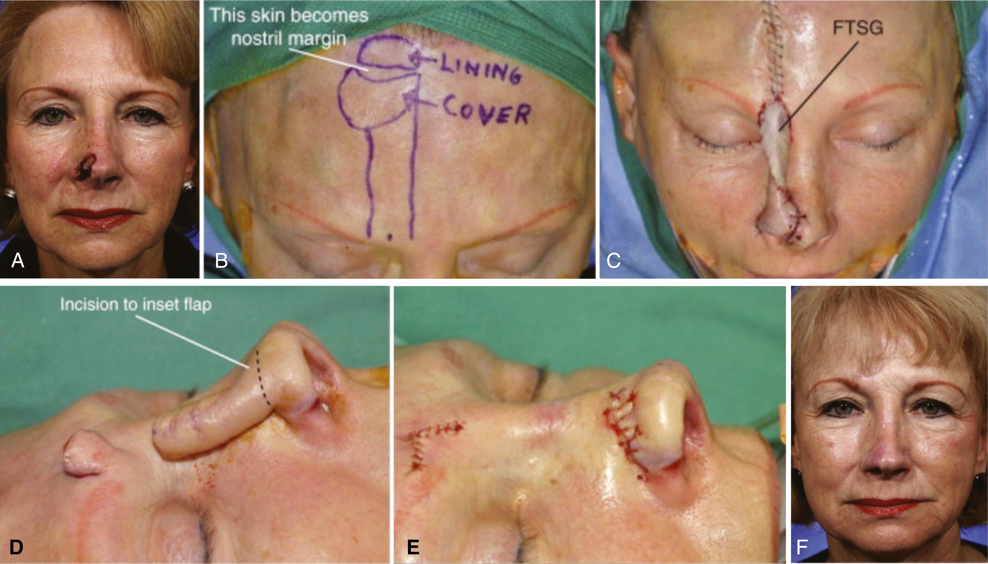 Fig. 69.7, (A) Full-thickness defect of nasal tip. (B) Paramedian forehead flap design with (intranasal lining, and external nasal skin). (C) First stage: paramedian forehead flap transferred to nose and inset. (D) Second stage: division of paramedian forehead flap. (E) Second stage: donor site is repaired and flap is inset. (F) Postoperative view.