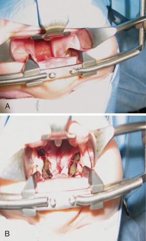 E-FIGURE 35.3, Oral views before (A) and after (B) repair of cleft palate. Closure of the cleft palate is possible through tension-releasing incisions. The oropharyngeal space is dramatically reduced at the end of the procedure. Children unable to mouth breathe before surgery (e.g., those with a very small mandible) are dependent on patent nasal airways at the end of the procedure.