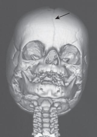 E-FIGURE 35.4, Frontal three-dimensional magnetic resonance imaging of a child with sagittal craniosynostosis. Note closed sagittal suture in the skull midline ( arrow ).