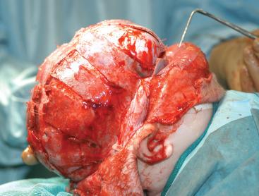 FIGURE 35.4, Child immediately before surgical closure after total cranial vault reshaping using strip craniectomy for sagittal craniosynostosis.