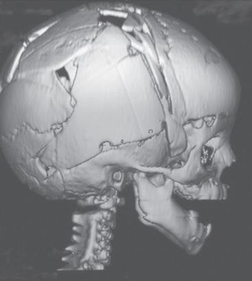 E-FIGURE 35.5, Three-dimensional magnetic resonance imaging of a child after extended strip craniectomy (see Fig. 35.4 ). This approach is commonly used in infants younger than 6 months of age. To protect the fragile skull bones, a protective helmet must be worn after surgery until cranial remodeling is complete.