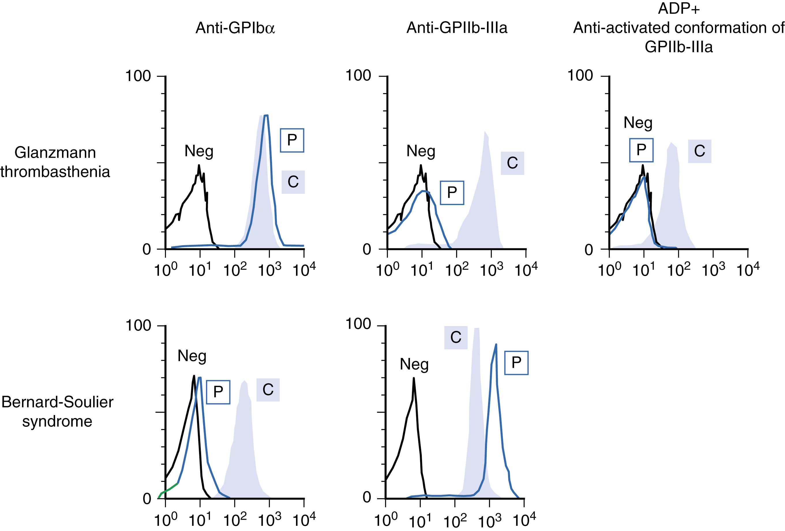 Figure 41.4, Flow cytometric evaluation of platelet membrane glycoprotein (GP) disorders, Glanzmann thrombasthenia, and Bernard-Soulier syndrome. Platelets from healthy controls (C) or from patients (P) were incubated with monoclonal antibodies against GPIbα, GPIIb-IIIa, or a monoclonal antibody (PAC-1) that recognizes only the conformationally altered active form of GPIIb-IIIa that occurs following platelet activation (e.g., in response to ADP). In the patient with Glanzmann thrombasthenia (upper panel) , there is virtual absence of GPIIb-IIIa, although GPIbα is present at normal levels. In the patient with Bernard-Soulier syndrome (lower panel) , a severe deficiency of GPIbα expression but no decrease in GPIIb-IIIa expression is seen.