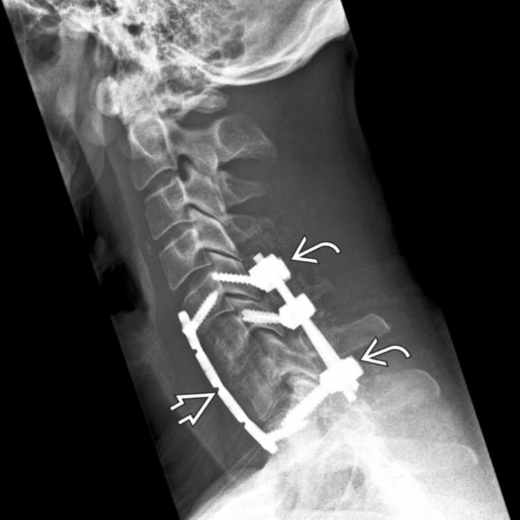 Lateral radiograph shows multilevel anterior cervical discectomy and fusion spanning C5-T1 . Lateral mass fixation is the gold standard in the presence of postlaminectomy instability and incompetency of posterior elements .