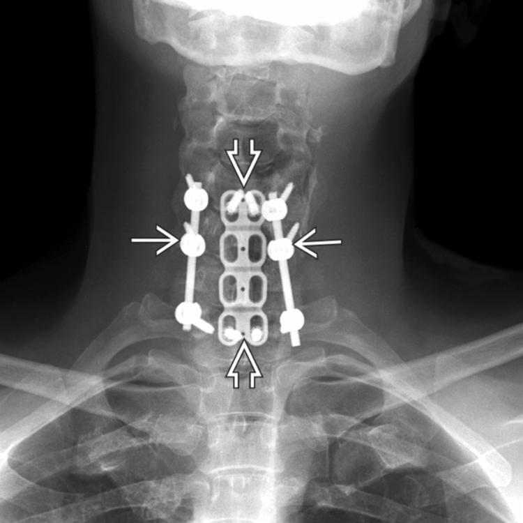 Dynamic plates allow some motion at screw-plate interface. By allowing the graft to subside, a higher fusion rate is obtained. Lateral mass plating resists rotational and extension forces more effectively than posterior cervical wiring techniques.