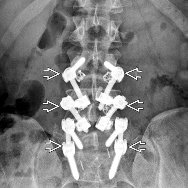 Patients with spondylolysis show higher incidence of spondylolisthesis or degenerative disc disease at the level of pars defects and at the upper adjacent level. AP plain film in the same patient shows pedicle screw-rod-hook constructs .