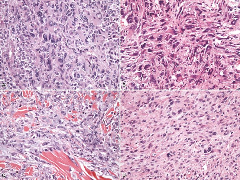 Figure 7.2, Nonmesenchymal Neoplasms Mimicking Undifferentiated Pleomorphic Sarcoma.