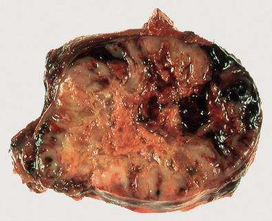 Figure 7.3, Characteristic Gross (Macroscopic) Appearance of Undifferentiated Pleomorphic Sarcoma.