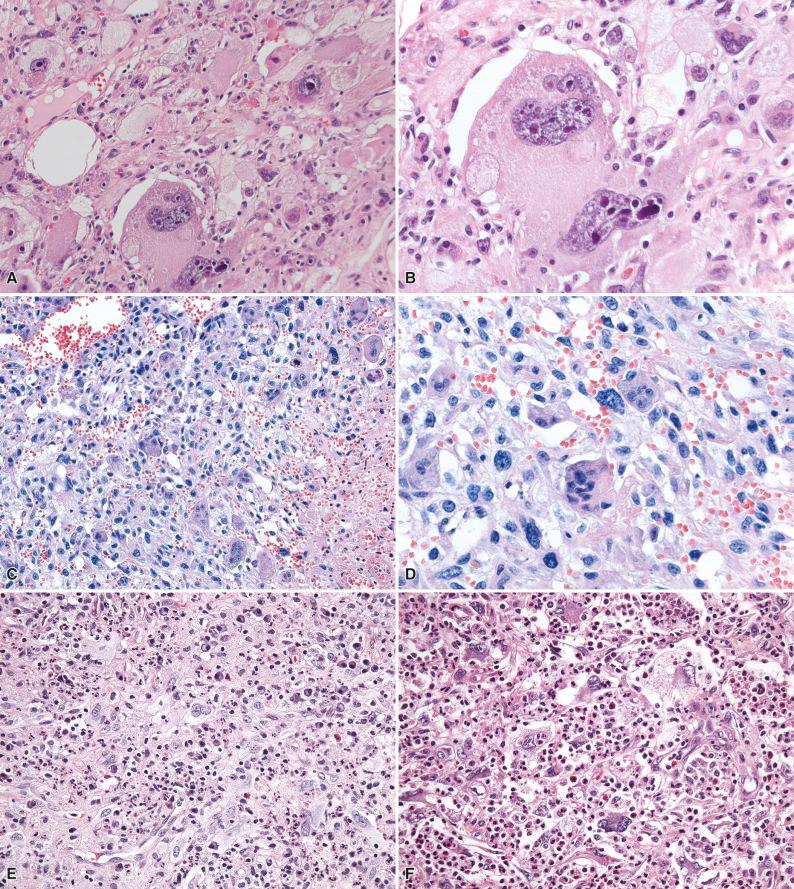 Figure 7.4, Undifferentiated Pleomorphic Sarcoma.