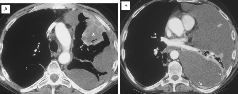 FIG. 33.1, Lung carcinoma involving the pleura. (A) On this chest computed tomography (CT) scan, a peripheral lung adenocarcinoma (∗) directly invades the pleura. (B) Additional metastases separate from the primary tumor appear as pleural nodules (arrows).