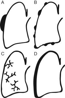 FIG. 33.2, Patterns of pleural involvement by extrapleural neoplasms. (A) Pleural mass or nodule. (B) Studding by multiple small nodules. (C) Lymphangitic involvement. (D) “Pseudomesotheliomatous” distribution.