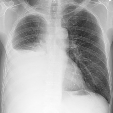 Fig. 74.1, Malignant pleural mesothelioma (MPM): radiographic features. Frontal chest radiograph demonstrates a large right pleural effusion. A unilateral pleural effusion is one of the most common manifestations of MPM and is present in 30%–80% of patients on chest radiography.