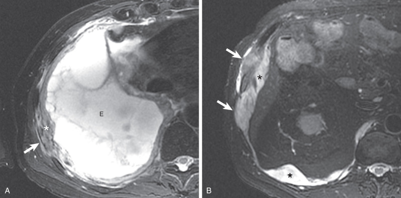 Fig. 74.11, Chest wall invasion of malignant pleural mesothelioma (MPM) on magnetic resonance imaging (MRI). (A) Axial T2-weighted MRI shows focal invasion of the right chest wall (arrow) by tumor (asterisk) with associated large pleural effusion (E). (B) Axial T2-weighed MRI from a different patient demonstrates multifocal invasion (arrows) of the right chest wall and a small right pleural effusion (asterisk) . MPM with multifocal or diffuse invasion of the chest wall is typically considered unresectable.