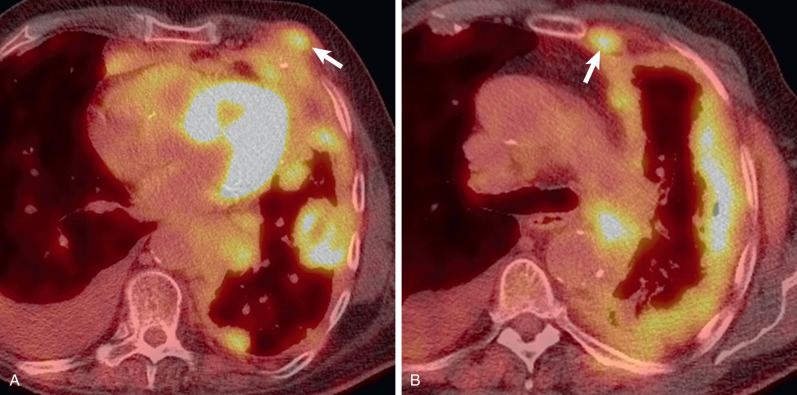 Fig. 74.12, Positron emission tomography (PET)-CT of malignant pleural mesothelioma. Fused axial fluorodeoxyglucose (FDG)–PET-CT images demonstrate extensive FDG-avid pleural thickening, nodules, and masses in the left hemithorax with focal invasion of the chest wall ( arrow , A) and an FDG-avid left internal mammary lymph node ( arrow , B) compatible with lymph node metastasis.