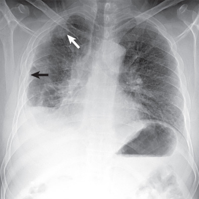 Fig. 74.2, Malignant pleural mesothelioma: radiographic features. Frontal chest radiograph demonstrates pleural thickening (black arrow) and focal pleural nodules (white arrow) in the right hemithorax.