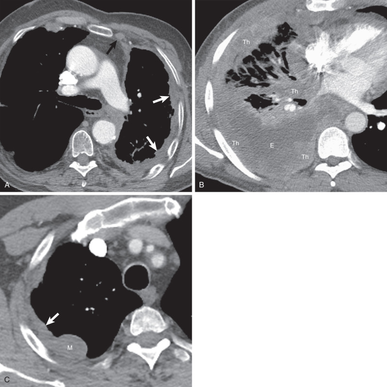 Fig. 74.4, Malignant pleural mesothelioma: CT features. (A) Contrast-enhanced axial CT shows pleural thickening (white arrows) in the left hemithorax. Note the enlarged left internal mammary lymph node (black arrow) representing lymph node metastasis. (B) Contrast-enhanced axial CT from a different patient demonstrates a right pleural effusion (E) and extensive pleural thickening (Th) in the right hemithorax. Note the extension along the interlobar fissures. (C) Contrast-enhanced axial CT of a third patient shows pleural thickening (arrow) and a pleural mass (M) in the right hemithorax.