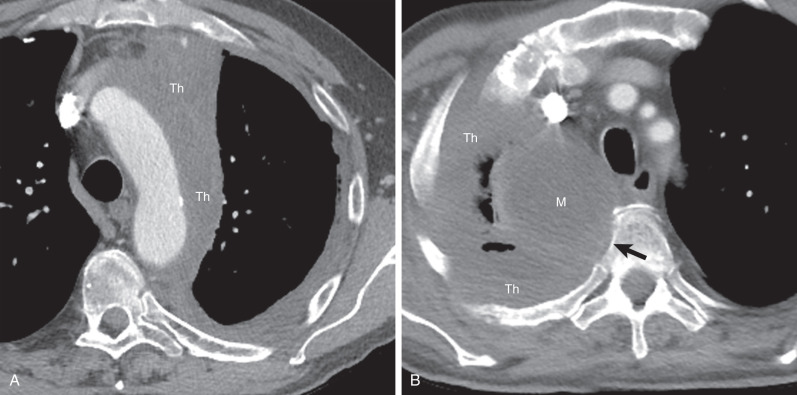 Fig. 74.5, Malignant pleural mesothelioma (MPM) with mediastinal invasion. (A) Contrast-enhanced axial CT demonstrates extensive pleural thickening (Th) in the left hemithorax that invades the mediastinum and the aortic arch. (B) Contrast-enhanced axial CT of a different patient shows pleural thickening (Th) in the right hemithorax and a focal mass (M) that invades the adjacent thoracic spine (arrow). MPM may invade the mediastinum and result in the loss of fat and tissue planes between mediastinal structures. Invasion should also be suspected when the mass encases >50% of the circumference of the trachea, esophagus, or other mediastinal structures.