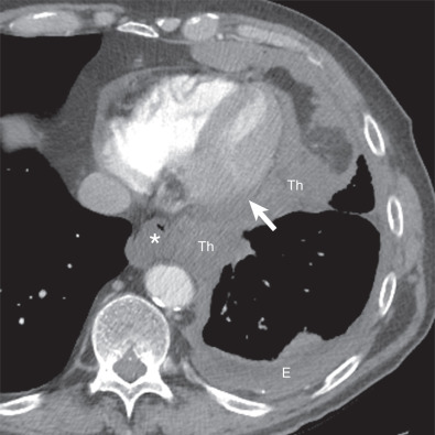 Fig. 74.6, Malignant pleural mesothelioma with pericardial involvement. Contrast-enhanced axial CT demonstrates a left pleural effusion (E) and pleural thickening (Th) that invades the esophagus (asterisk) and pericardium (arrow). Involvement of the pericardium, which may be nontransmural or transmural, may produce pericardial effusion, pericardial thickening, pericardial nodules/masses, and/or infiltrating soft tissue.