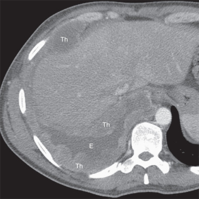 Fig. 74.8, Transdiaphragmatic extension of malignant pleural mesothelioma (MPM). Contrast-enhanced axial CT demonstrates a pleural effusion (E) and extensive pleural thickening (Th) in the right hemithorax. Note the loss of the normal fat plane between the inferior surface of the diaphragm and the liver, suggestive of transdiaphragmatic extension. The accuracy of CT for transdiaphragmatic extension remains poor; however, the presence of a distinct fat plane between the inferior surface of the diaphragm and the adjacent abdominal organs is the most reliable indication that MPM is limited to the chest.