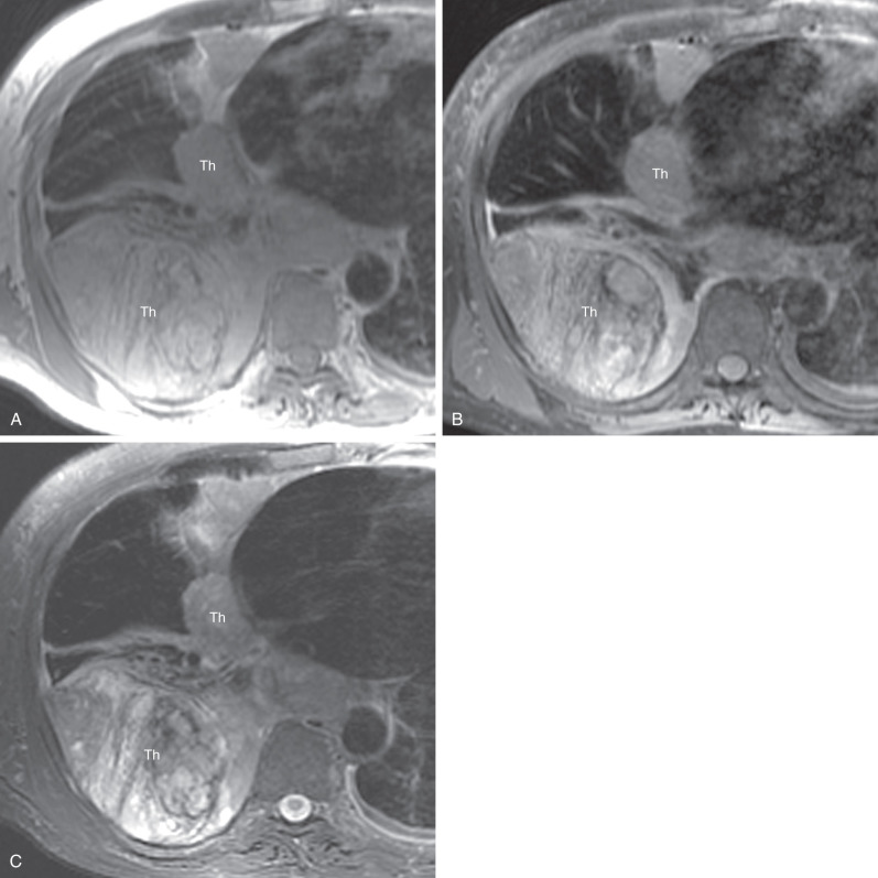 Fig. 74.10, Magnetic resonance imaging (MRI) of malignant pleural mesothelioma. Axial T1-weighed MRIs before (A) and after (B) the administration of intravenous contrast demonstrates pleural thickening (Th) in the right hemithorax that is hyperintense to muscle and enhances after gadolinium administration. (C) Axial T2-weighted MRI demonstrates the tumor to be hyperintense to muscle but heterogeneous.